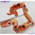 PNT-07451 Modelo intestinal humano Disease Large Intestines model for education